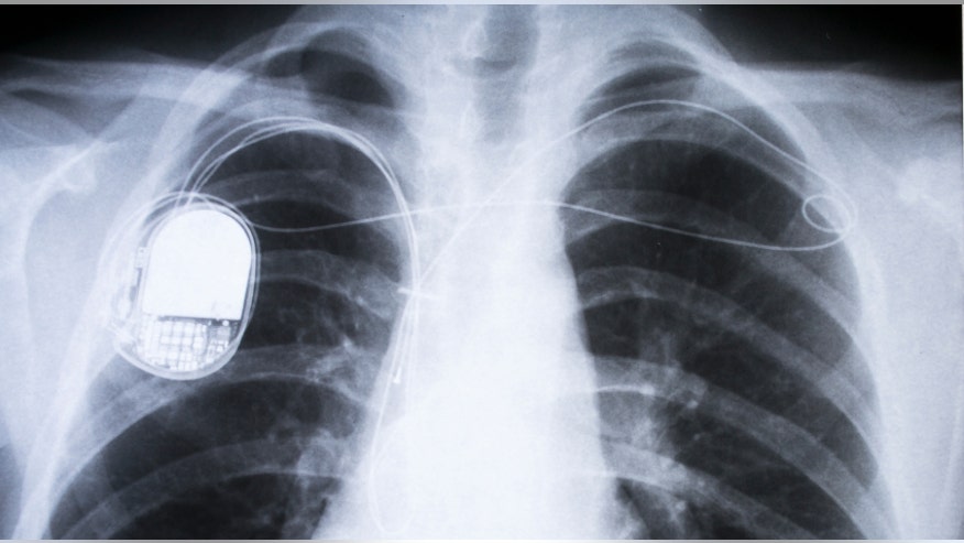 Pacemaker istock.jpg